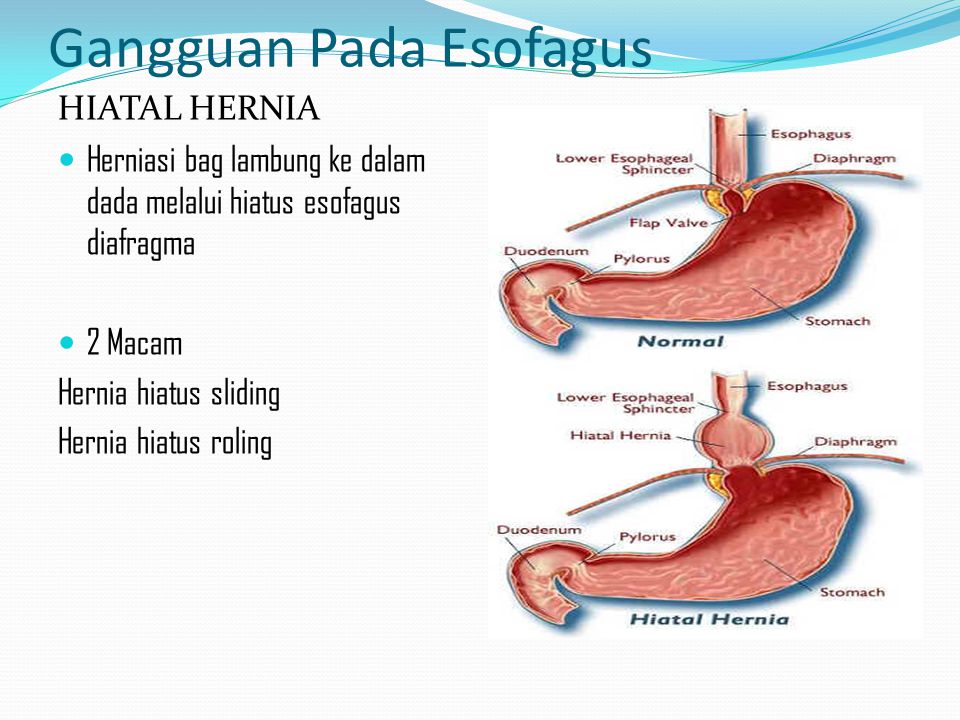 Jengibre y hernia de hiato